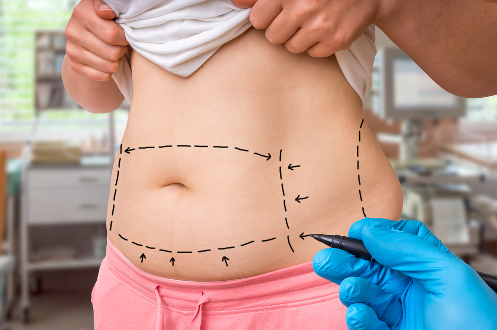 Tummy Tuck Surgery