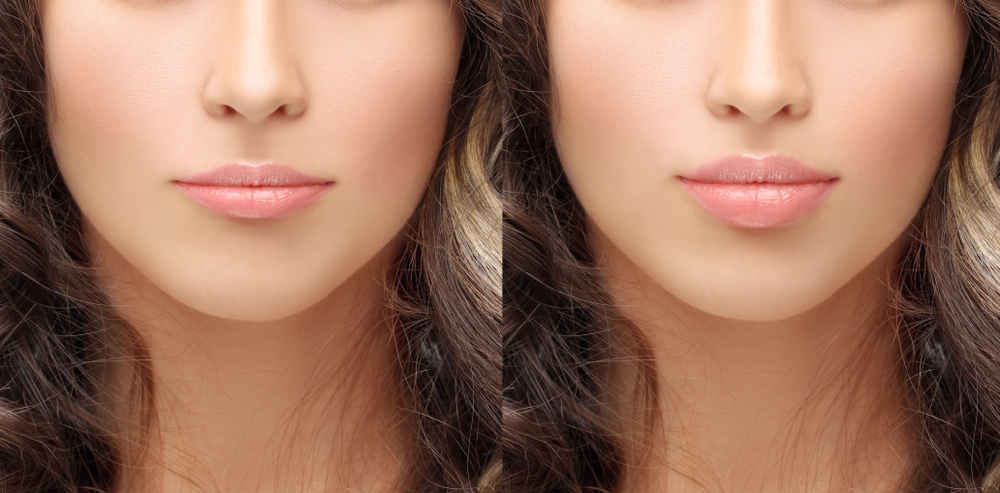 Lip Augmentation
