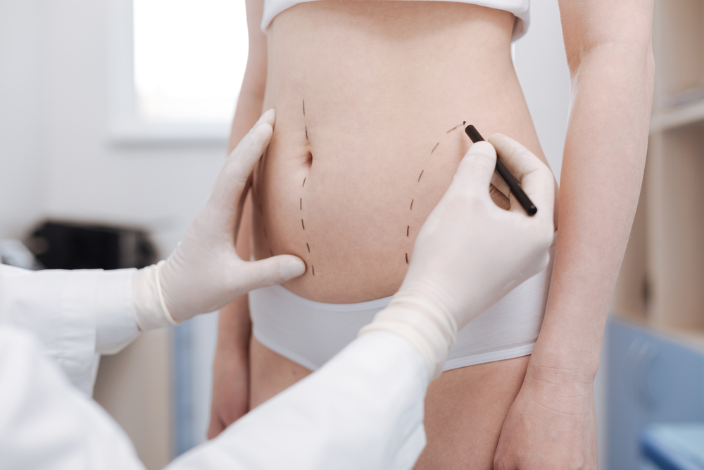 Liposuction Surgery