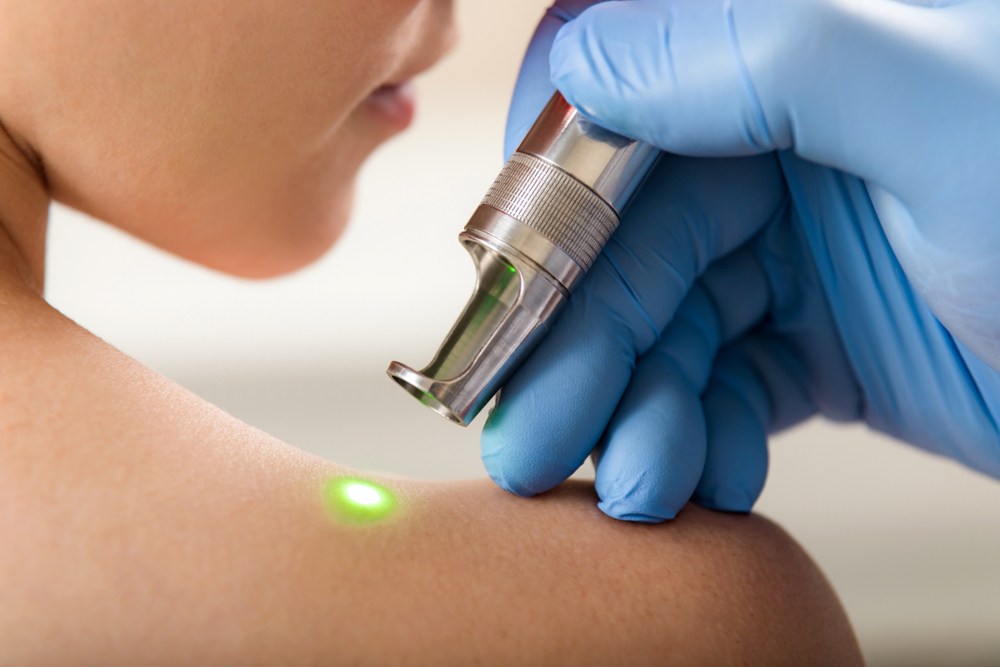 Mole Removal