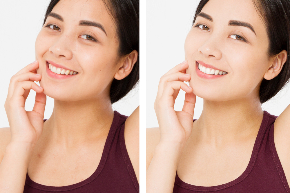Facial Implants
