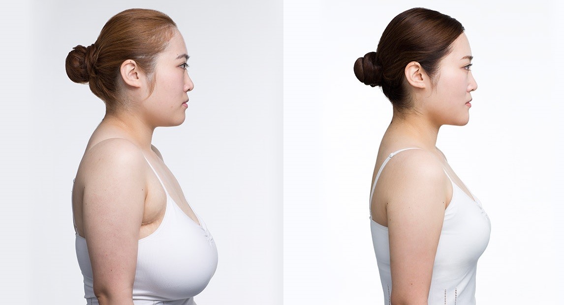 Breast Reduction Surgery