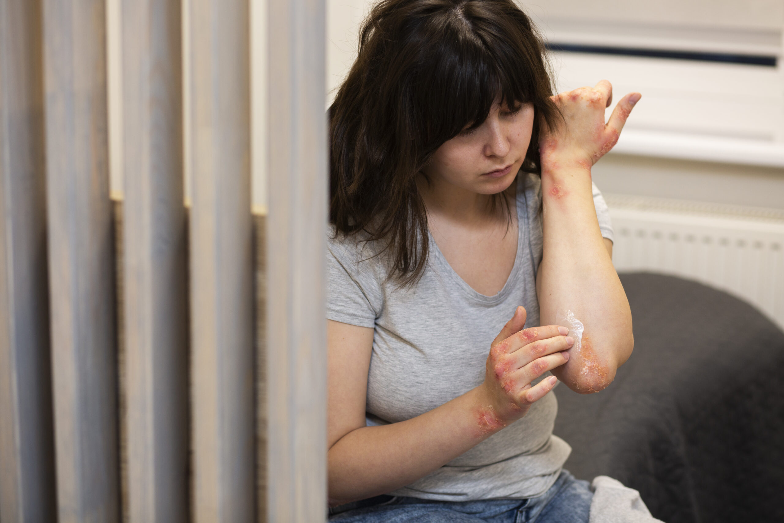 Small Burn Injuries