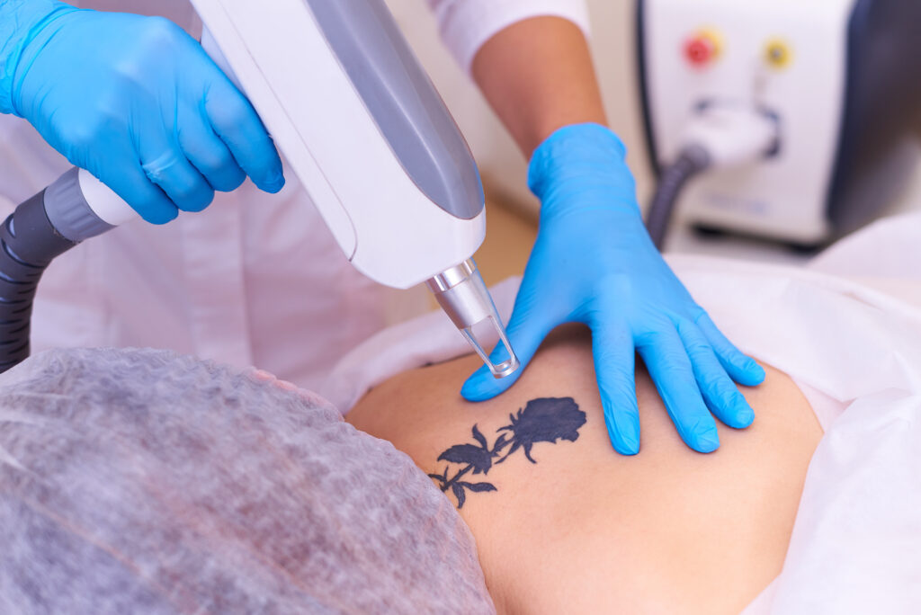 How Many Sessions Does It Take to Remove a Tattoo Completely?