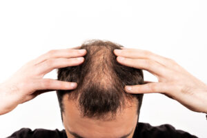 Hair Transplant Surgery