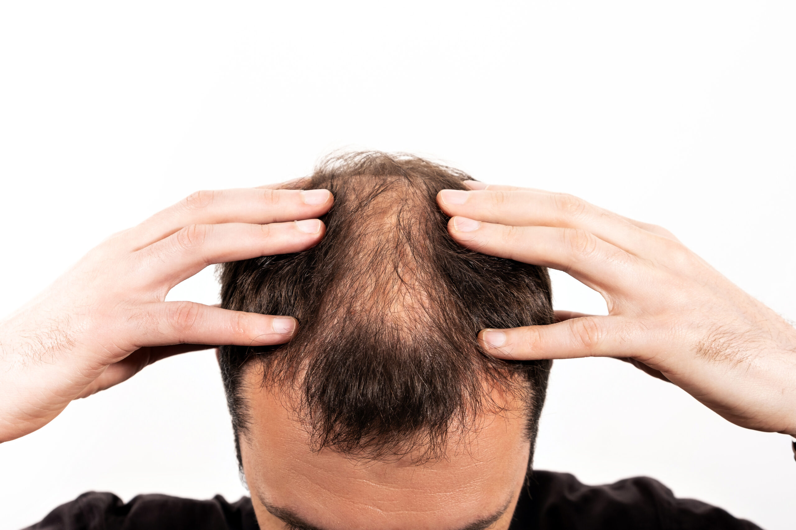 Hair Transplant Surgery