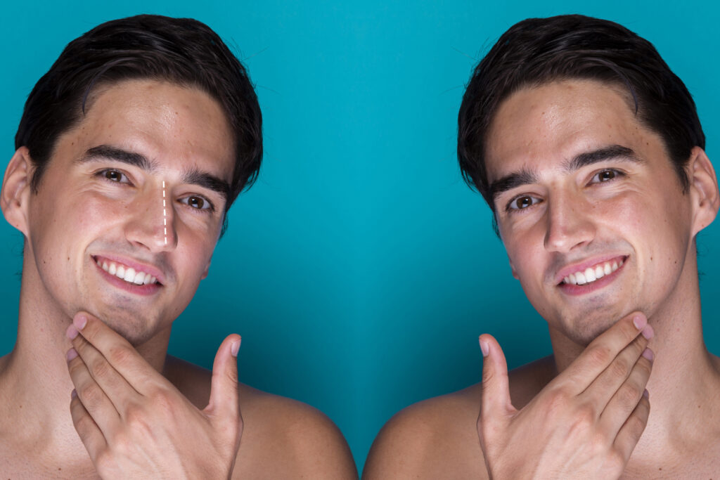 Rhinoplasty | Nose Surgery: A Complete Guide to Transformative Results at Elegance Skin & Cosmetic Clinic