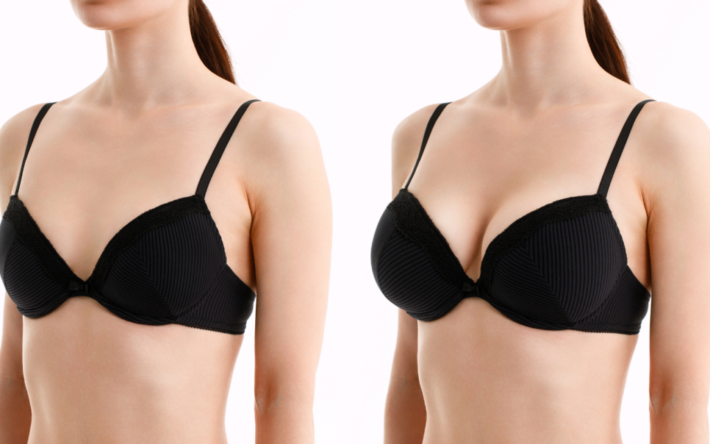 The Evolution of Breast Augmentation Surgery: From Past to Present