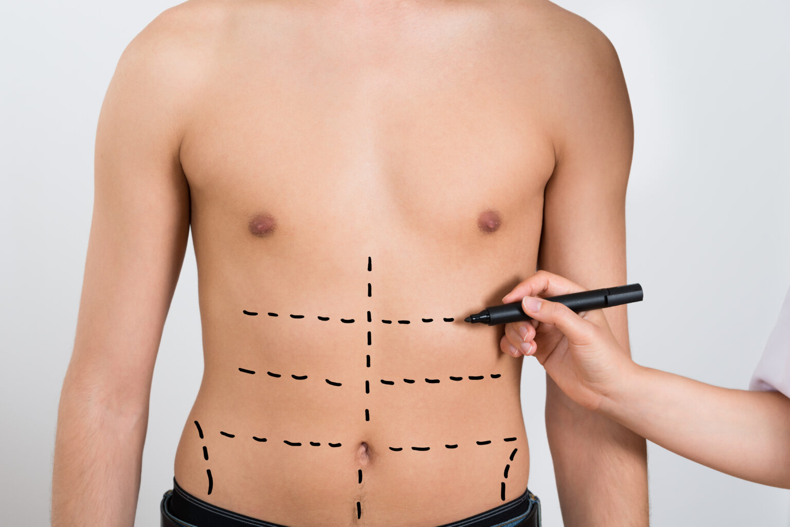 Best Gynecomastia surgery in Ahmedabad