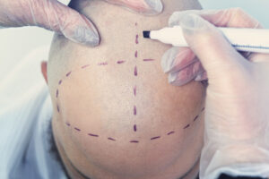 Hair Transplant Surgery