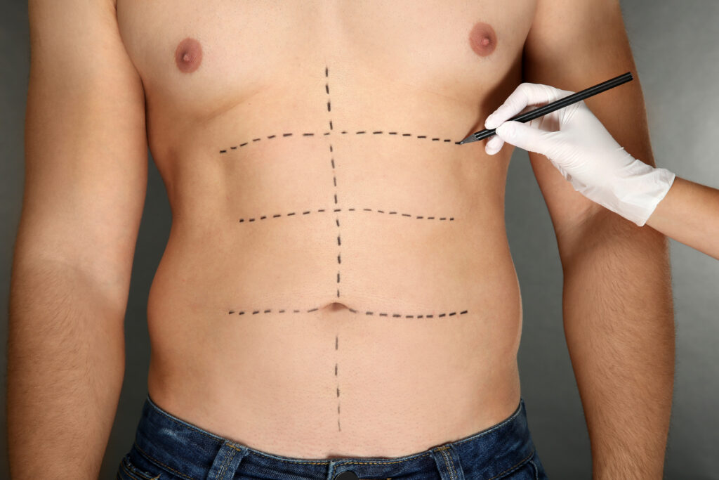 Is Gynecomastia Surgery Safe? Risks, Complications and How to Minimise Them