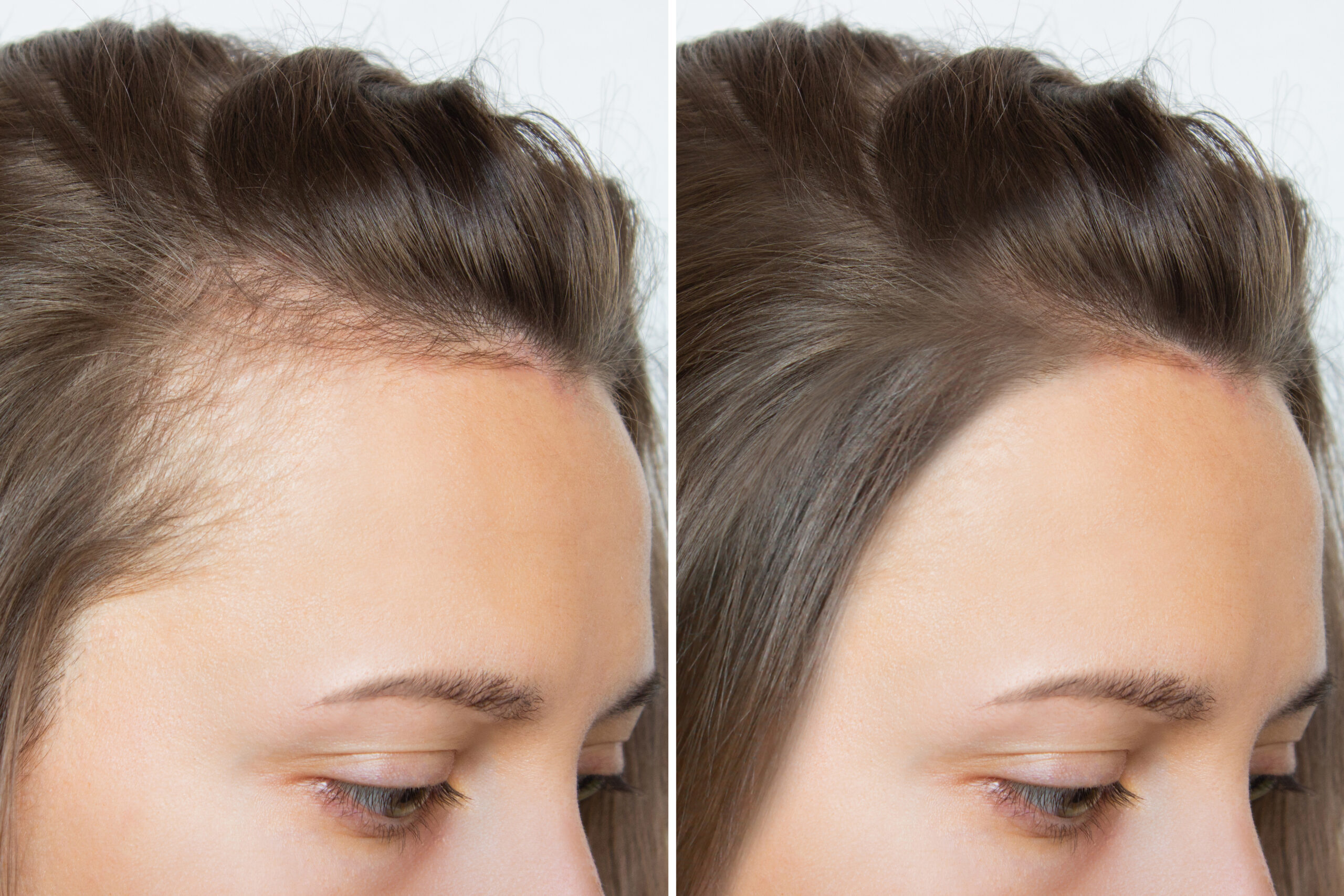 Hair Transplant for Women in Ahmedabad