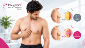 Best Gynecomastia surgery in ahmedabad
